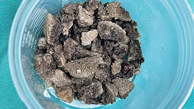 8 santimetrelik 'geyik boynuzu' böbrek taşı kapalı yöntemle çıkarıldı